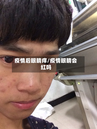 疫情后眼睛痒/疫情眼睛会红吗-第1张图片